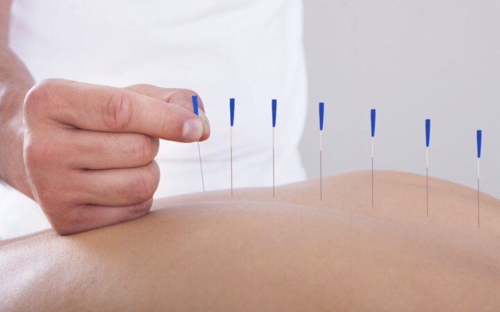 Benefits of Acupuncture for Chronic Pain Relief
